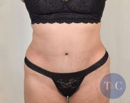 Tummy Tuck Before & After Patient #286