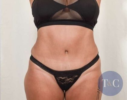 Tummy Tuck Before & After Patient #301