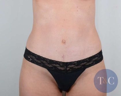 Tummy Tuck Before & After Patient #346