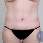Tummy Tuck Before & After Patient #351