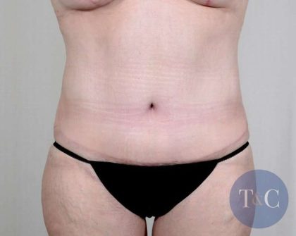 Tummy Tuck Before & After Patient #351