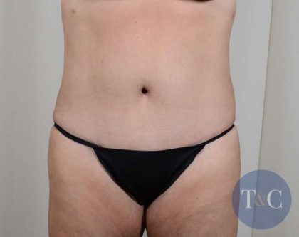 Tummy Tuck Before & After Patient #356