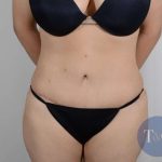 Tummy Tuck Before & After Patient #361