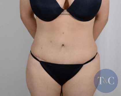 Tummy Tuck Before & After Patient #361