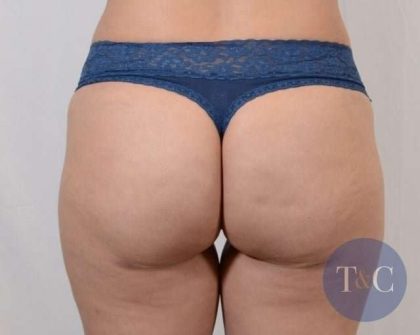 Brazilian Butt Lift Before & After Patient #413