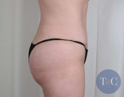 Brazilian Butt Lift Before & After Patient #418