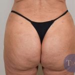 Brazilian Butt Lift Before & After Patient #423