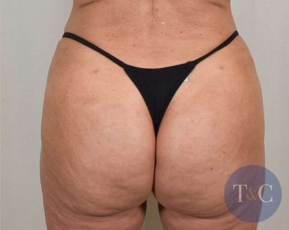 Brazilian Butt Lift Before & After Patient #423