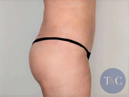 Brazilian Butt Lift Before & After Patient #428