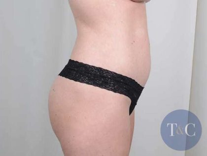 Brazilian Butt Lift Before & After Patient #433