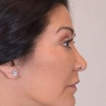 Liposuction Before & After Patient #438