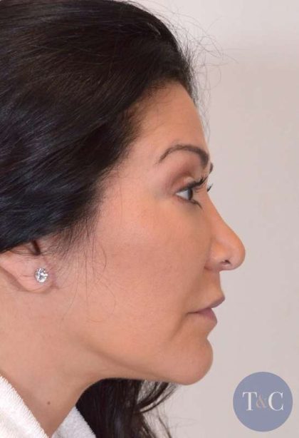 Liposuction Before & After Patient #438