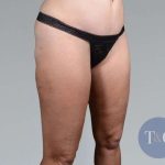 Liposuction Before & After Patient #448