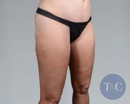 Liposuction Before & After Patient #448