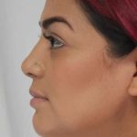Liposuction Before & After Patient #458