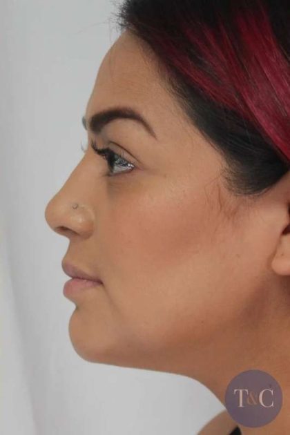 Liposuction Before & After Patient #458