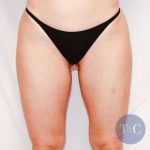 Liposuction Before & After Patient #468