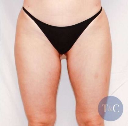Liposuction Before & After Patient #468