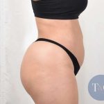 Liposuction Before & After Patient #480