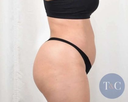 Liposuction Before & After Patient #480