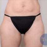 Liposuction Before & After Patient #491