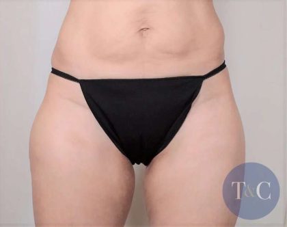 Liposuction Before & After Patient #491