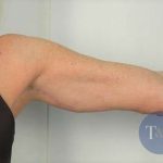 Arm Lift Before & After Patient #496