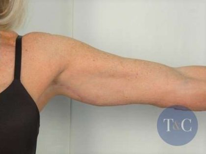 Arm Lift Before & After Patient #496