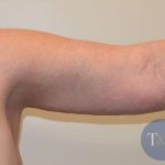 Arm Lift Before & After Patient #501