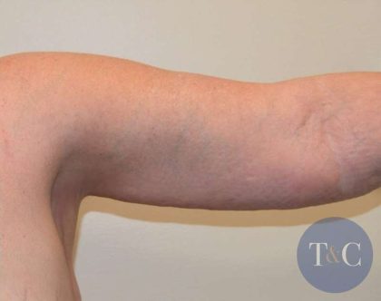 Arm Lift Before & After Patient #501