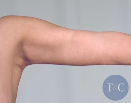 Arm Lift Before & After Patient #506