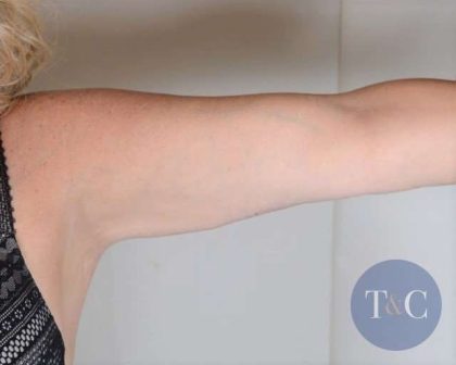 Arm Lift Before & After Patient #511