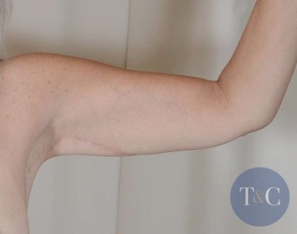 Arm Lift Before & After Patient #516