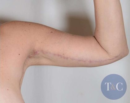Arm Lift Before & After Patient #521