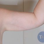 Arm Lift Before & After Patient #526