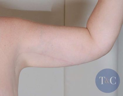 Arm Lift Before & After Patient #526