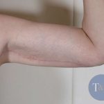Arm Lift Before & After Patient #531