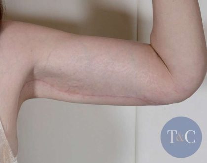 Arm Lift Before & After Patient #531