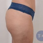 Brazilian Butt Lift Before & After Patient #413