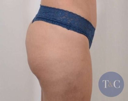Brazilian Butt Lift Before & After Patient #413