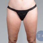 Liposuction Before & After Patient #448