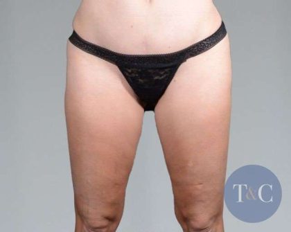 Liposuction Before & After Patient #448