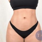Liposuction Before & After Patient #480