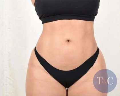 Liposuction Before & After Patient #480