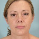 Neck Lift Before & After Patient #1157