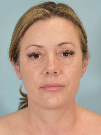 Neck Lift Before & After Patient #1157