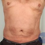 Men's Liposuction Before & After Patient #1396