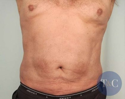 Men's Liposuction Before & After Patient #1396