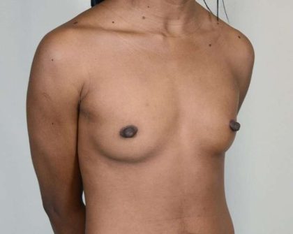 Breast Augmentation Before & After Patient #571
