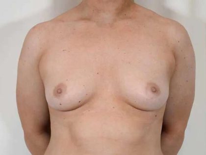 Breast Augmentation Before & After Patient #591